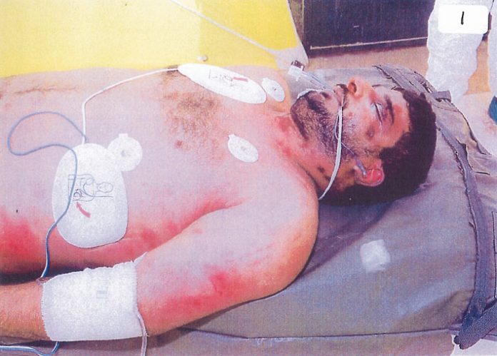 Left side view of upper body of Baha Daoud Salim Musa after his death in British military custody in Iraq in September 2003