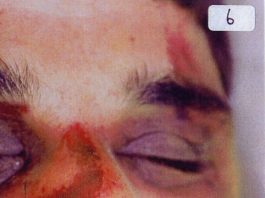 BAHA MOUSA INQUIRY ‘MUST LOOK AT ALL CASES AND ISSUES’ – insists lawyer The battered face of Baha Mousa showing some of his injuries