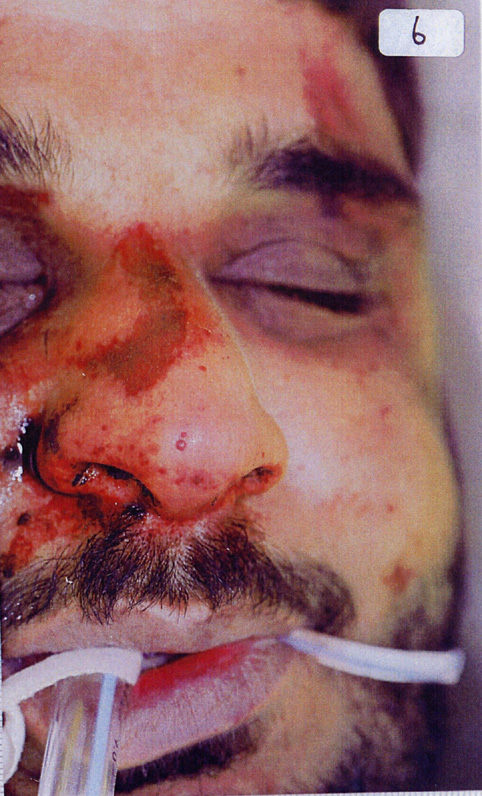 The battered face of Baha Mousa showing some of his injuries