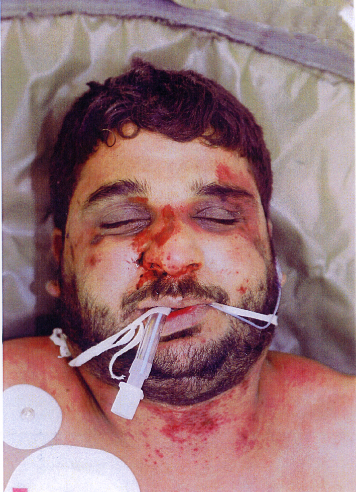 A very badly beaten Baha Mousa, an Iraqi hotel worker, tortured by British soldiers in Iraq