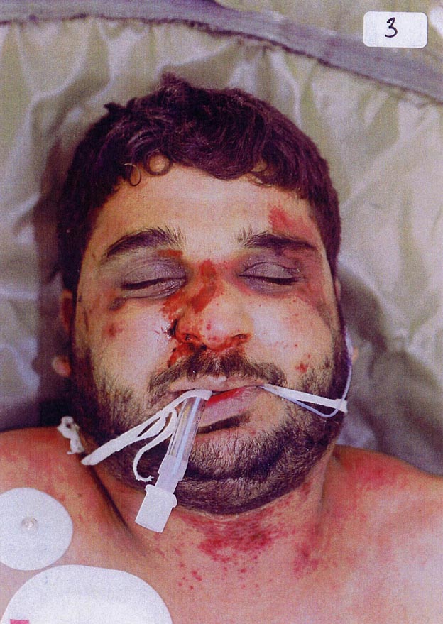 Badly beaten face of Baha Mousa after his death at the hands of British troops on 15 September 2003