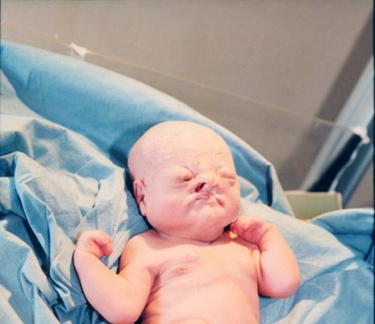 Baby born in Iraq with birth deformities (Photo credit: Karen Robinson)