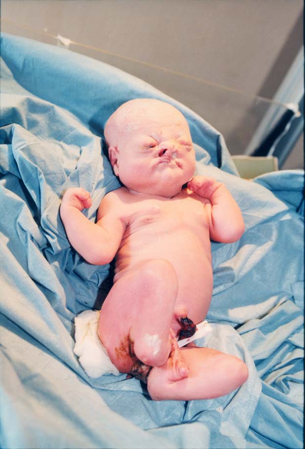 Baby born in Iraq with birth deformities (Photo credit: Karen Robinson)
