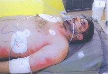 The body of Iraqi hotel worker, Baha Mousa after being beaten to death by British troops in Basra in September 2003