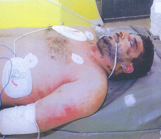 The body of Iraqi hotel worker, Baha Mousa after being beaten to death by British troops in Basra in September 2003