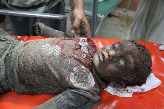 Hundreds of Palestinian children have been charred or badly burned by Israeli missile strikes