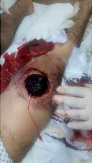 Gazan victim suffering massive bullet wound in his leg